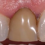 1 - Dente di protesi decolorato Dente di protesi decolorato