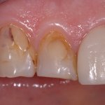 1 - Estetica compromessa da vecchie otturazioni infiltrate Estetica compromessa da vecchie otturazioni infiltrate