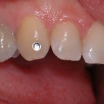 1 - Il brillantino viene incollato sul dente con adesivo trasparente fluido, come si fa per gli apparecchi ortodontici Il brillantino viene incollato sul dente con adesivo trasparente fluido, come si fa per gli apparecchi ortodontici
