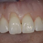 1 - La gengiva si è alzata di livello scoprendo alcuni millimetri di radice su diversi denti La gengiva si è alzata di livello scoprendo alcuni millimetri di radice su diversi denti.