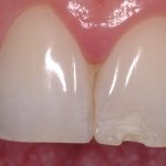 1 - Preparazione del dente Preparazione del dente